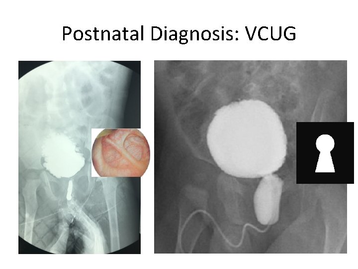 Postnatal Diagnosis: VCUG 