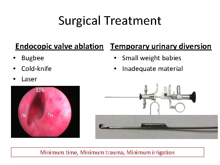 Surgical Treatment Endocopic valve ablation Temporary urinary diversion • Bugbee • Cold-knife • Laser