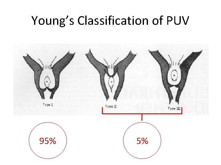 Young’s Classification of PUV 95% 5% 