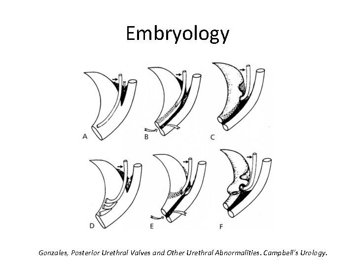 Embryology Gonzales, Posterior Urethral Valves and Other Urethral Abnormalities. Campbell’s Urology. 
