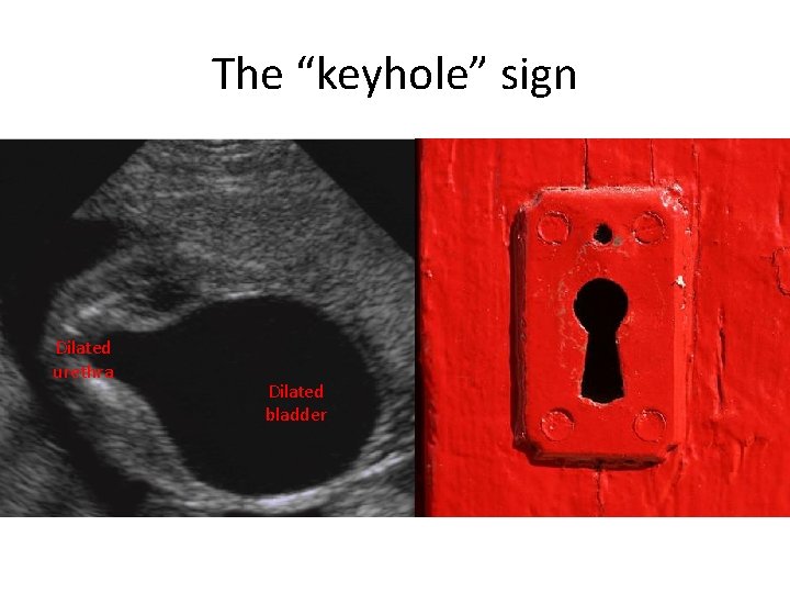 The “keyhole” sign Dilated urethra Dilated bladder 