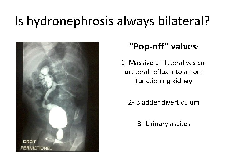 Is hydronephrosis always bilateral? “Pop-off” valves: 1 - Massive unilateral vesicoureteral reflux into a