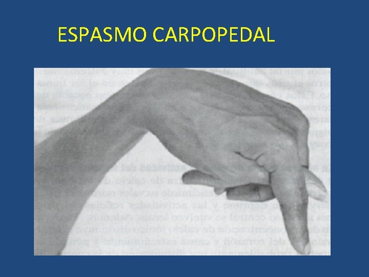 ESPASMO CARPOPEDAL ESPASMO CARPOPEDAL