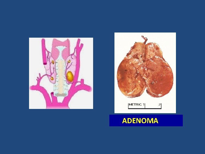 ADENOMA ADENOMA