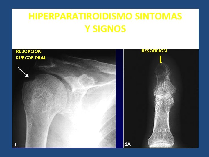 HIPERPARATIROIDISMO SINTOMAS Y SIGNOS RESORCION SUBCONDRAL AREA DE RESORCION HIPERPARATIROIDISMO SINTOMAS Y SIGNOS RESORCION SUBCONDRAL AREA DE RESORCION