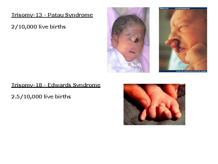Trisomy-13 - Patau Syndrome 2/10, 000 live births Trisomy-18 - Edwards Syndrome 2. 5/10,