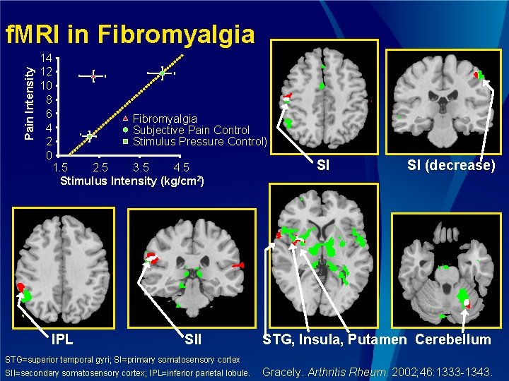 Pain Intensity f. MRI in Fibromyalgia 14 12 10 8 6 Fibromyalgia 4 Subjective