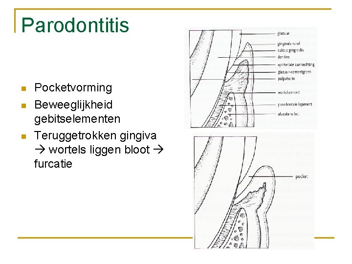 Parodontitis n n n Pocketvorming Beweeglijkheid gebitselementen Teruggetrokken gingiva wortels liggen bloot furcatie 