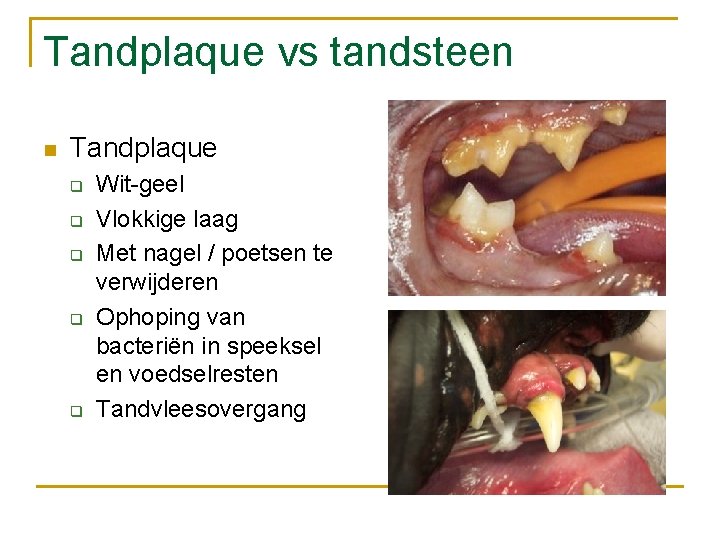 Tandplaque vs tandsteen n Tandplaque q q q Wit-geel Vlokkige laag Met nagel /