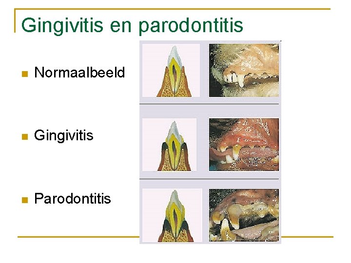 Gingivitis en parodontitis n Normaalbeeld n Gingivitis n Parodontitis 
