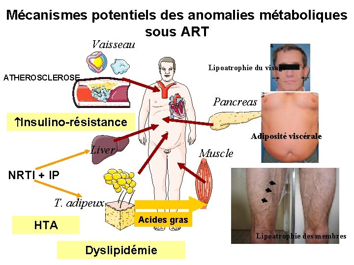 Mécanismes potentiels des anomalies métaboliques sous ART Vaisseau Lipoatrophie du visage ATHEROSCLEROSE Pancreas Insulino-résistance