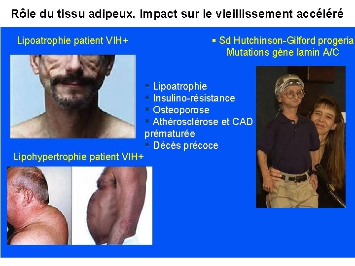 Rôle du tissu adipeux. Impact sur le vieillissement accéléré Lipoatrophie patient VIH+ § Sd