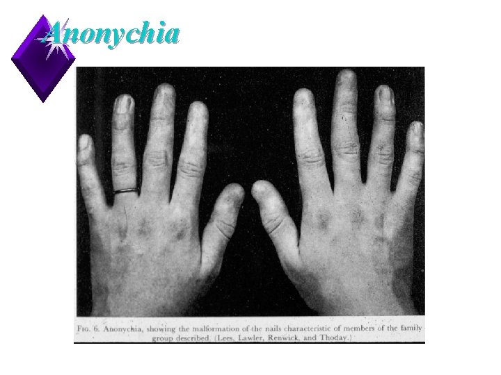 Anonychia 12 