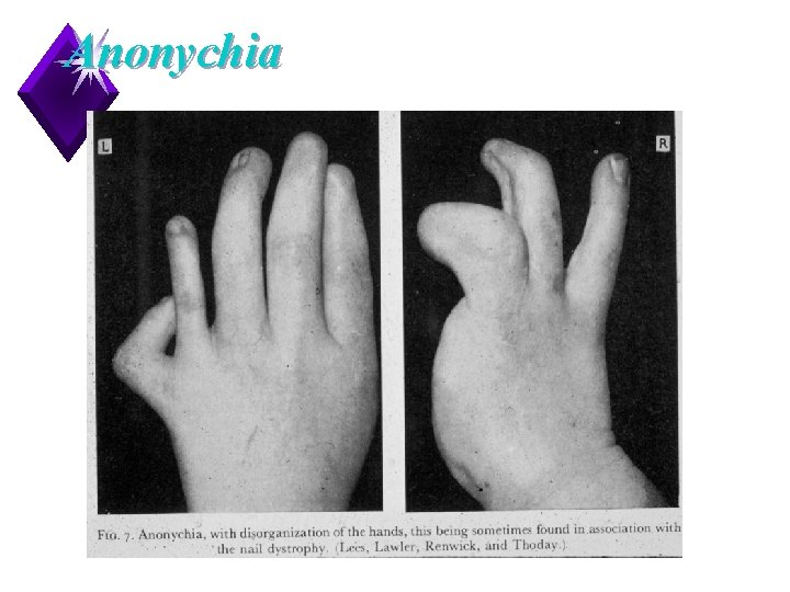 Anonychia 13 