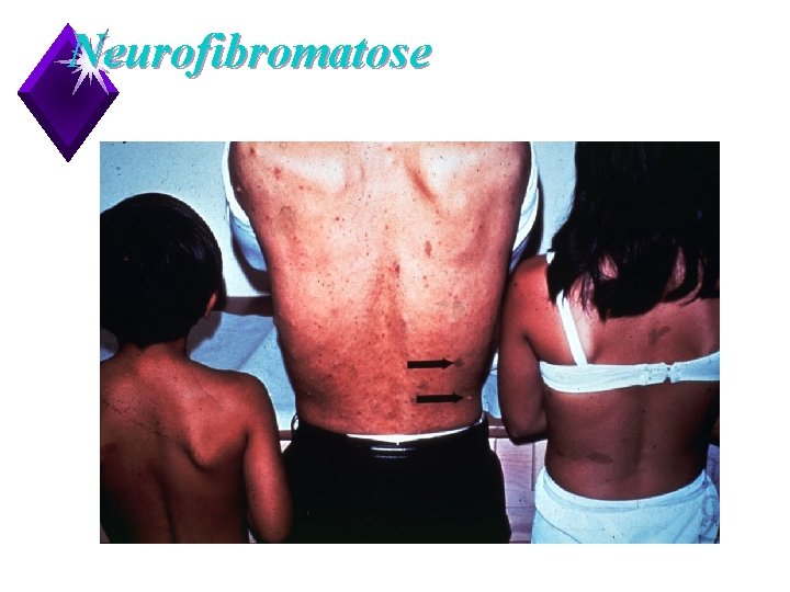 Neurofibromatose 14 