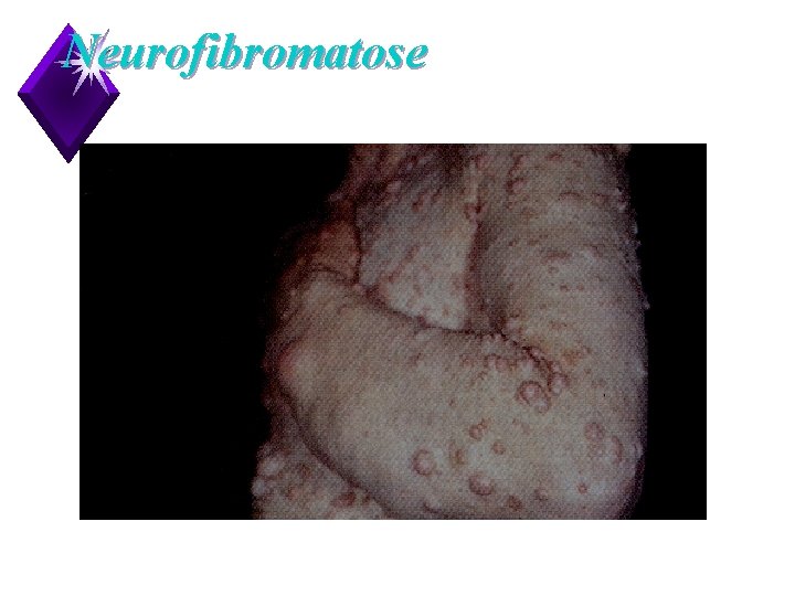 Neurofibromatose 15 