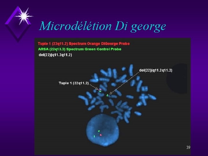 Microdélétion Di george 39 