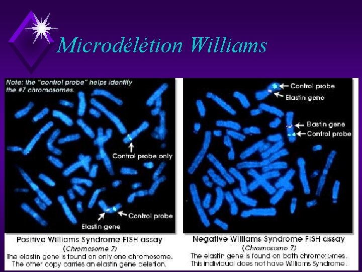 Microdélétion Williams 45 