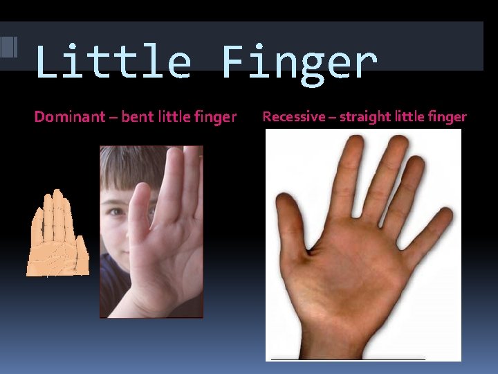 Little Finger Dominant – bent little finger Recessive – straight little finger 