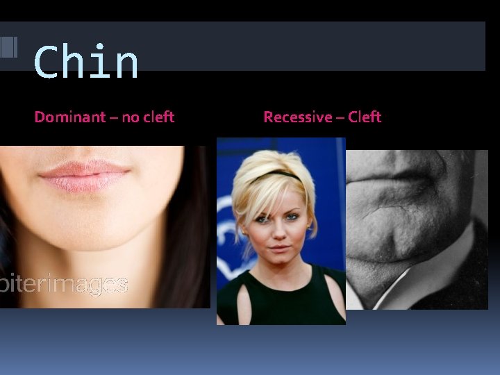 Chin Dominant – no cleft Recessive – Cleft 