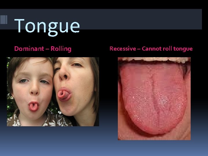 Tongue Dominant – Rolling Recessive – Cannot roll tongue 
