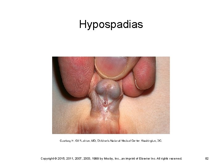 Hypospadias Copyright © 2015, 2011, 2007, 2003, 1999 by Mosby, Inc. , an imprint