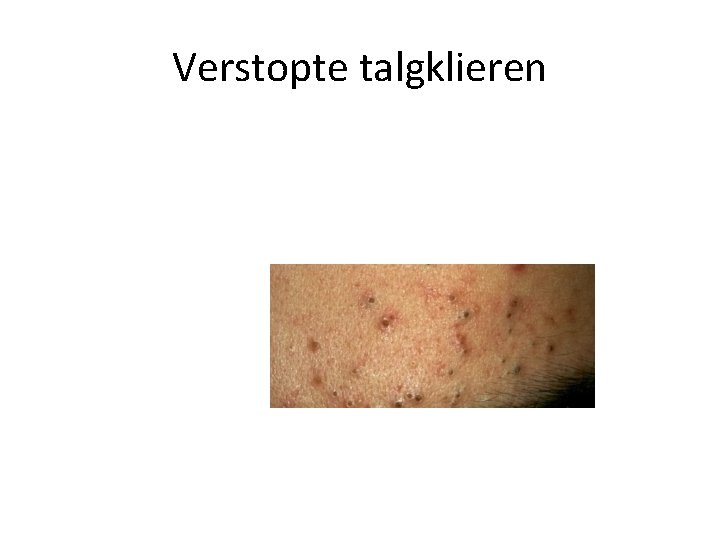 Verstopte talgklieren 