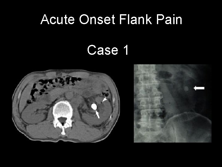 Acute Onset Flank Pain Case 1 