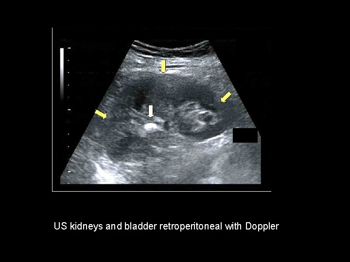 US kidneys and bladder retroperitoneal with Doppler 