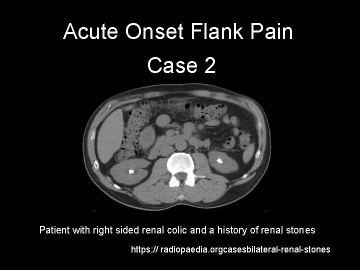 Acute Onset Flank Pain Case 2 Patient with right sided renal colic and a