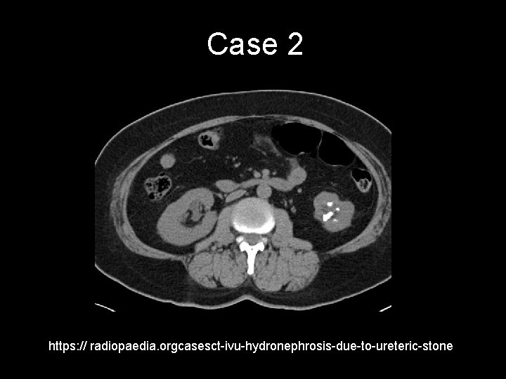 Case 2 https: // radiopaedia. orgcasesct-ivu-hydronephrosis-due-to-ureteric-stone 