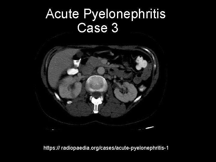 Acute Pyelonephritis Case 3 https: // radiopaedia. org/cases/acute-pyelonephritis-1 