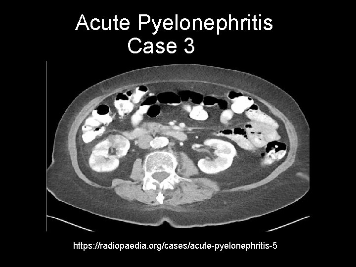 Acute Pyelonephritis Case 3 https: //radiopaedia. org/cases/acute-pyelonephritis-5 
