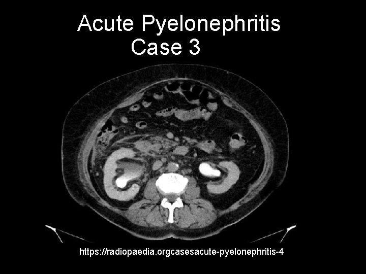 Acute Pyelonephritis Case 3 https: //radiopaedia. orgcasesacute-pyelonephritis-4 