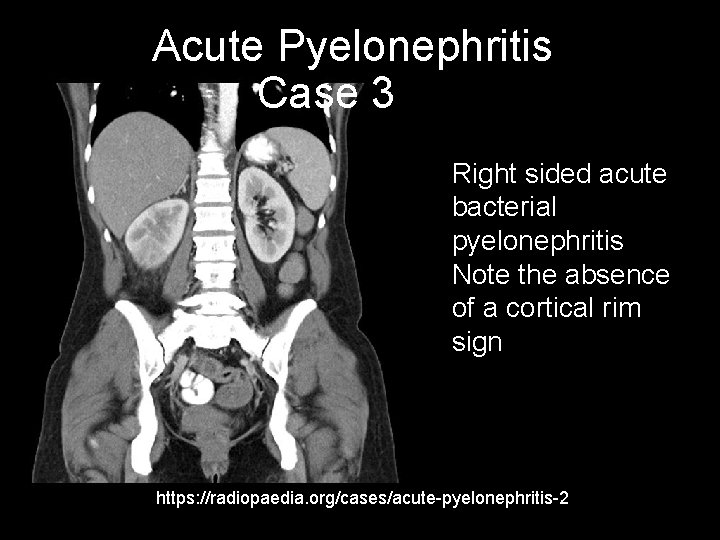 Acute Pyelonephritis Case 3 Right sided acute bacterial pyelonephritis Note the absence of a