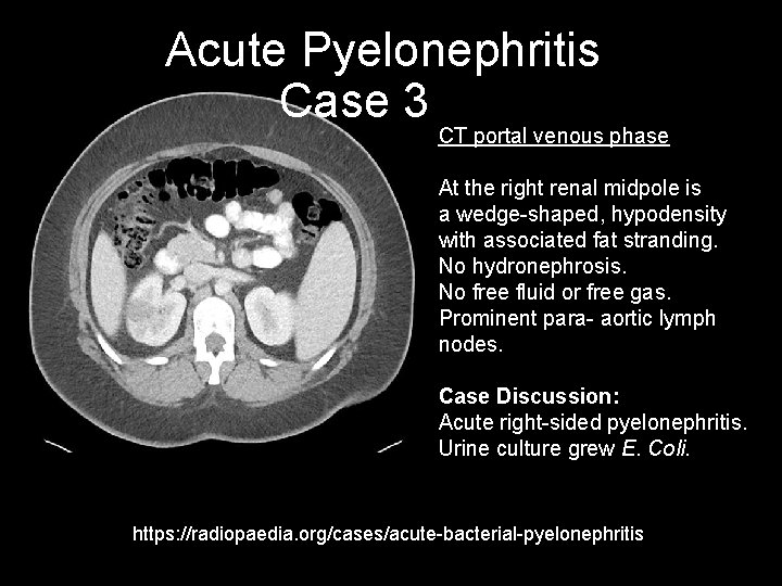 Acute Pyelonephritis Case 3 CT portal venous phase At the right renal midpole is