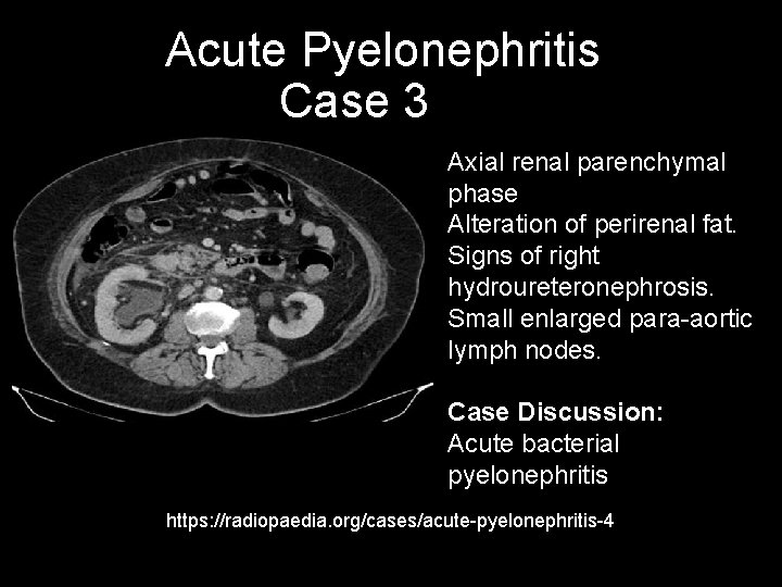 Acute Pyelonephritis Case 3 Axial renal parenchymal phase Alteration of perirenal fat. Signs of