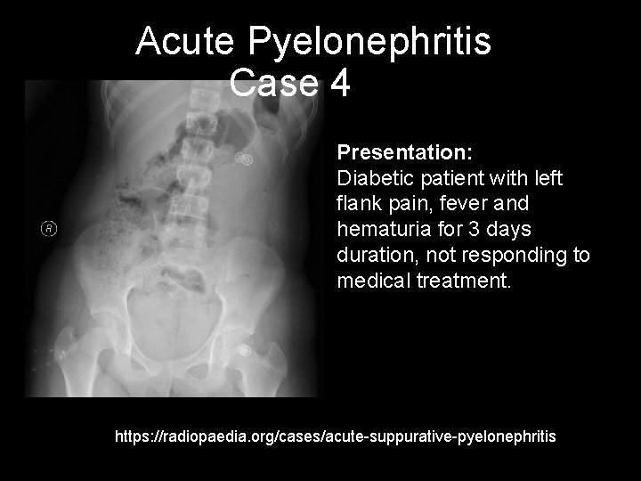 Acute Pyelonephritis Case 4 Presentation: Diabetic patient with left flank pain, fever and hematuria