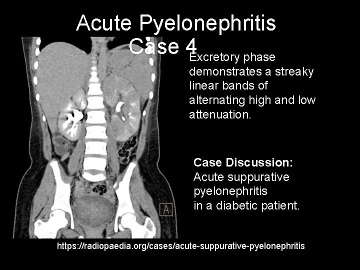 Acute Pyelonephritis Case 4 Excretory phase demonstrates a streaky linear bands of alternating high