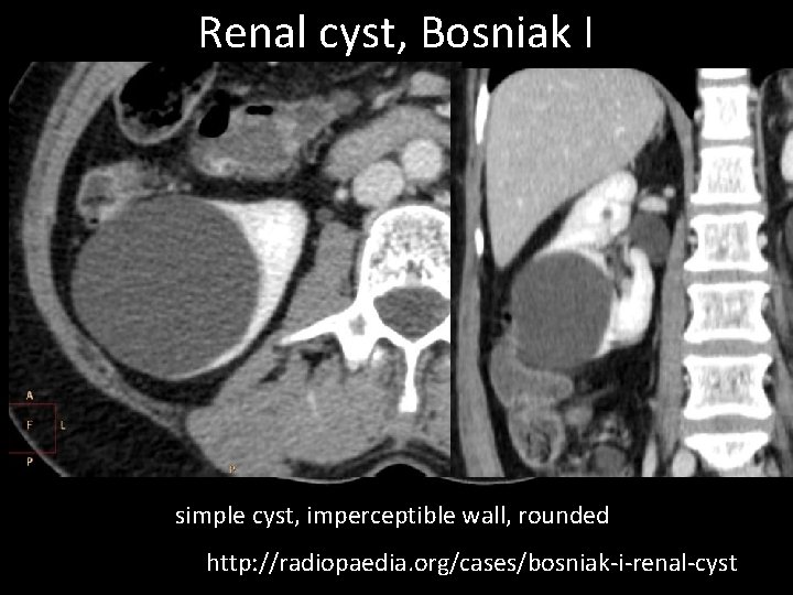 Renal cyst, Bosniak I simple cyst, imperceptible wall, rounded http: //radiopaedia. org/cases/bosniak-i-renal-cyst 