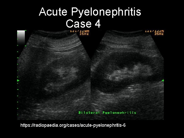 Acute Pyelonephritis Case 4 https: //radiopaedia. org/cases/acute-pyelonephritis-6 