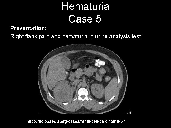 Hematuria Case 5 Presentation: Right flank pain and hematuria in urine analysis test http: