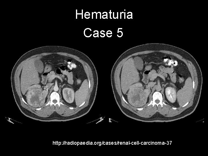 Hematuria Case 5 http: //radiopaedia. org/cases/renal-cell-carcinoma-37 