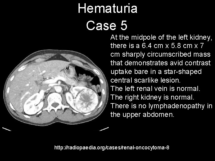 Hematuria Case 5 At the midpole of the left kidney, there is a 6.