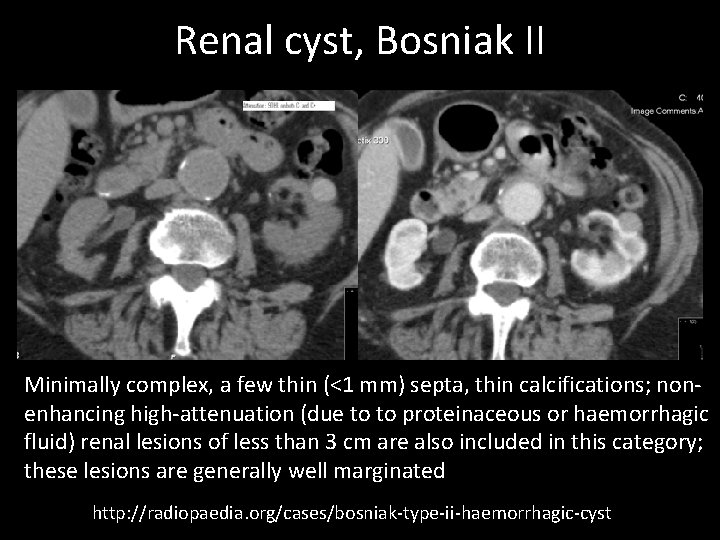 Renal cyst, Bosniak II Minimally complex, a few thin (<1 mm) septa, thin calcifications;