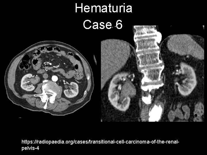 Hematuria Case 6 https: //radiopaedia. org/cases/transitional-cell-carcinoma-of-the-renalpelvis-4 