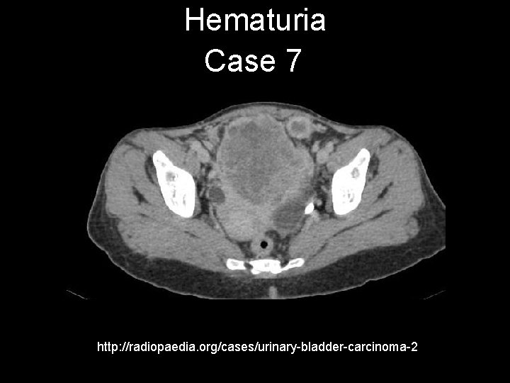 Hematuria Case 7 http: //radiopaedia. org/cases/urinary-bladder-carcinoma-2 
