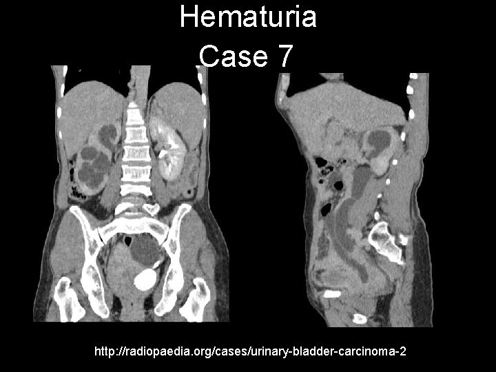 Hematuria Case 7 http: //radiopaedia. org/cases/urinary-bladder-carcinoma-2 