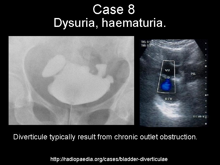 Case 8 Dysuria, haematuria. Diverticule typically result from chronic outlet obstruction. http: //radiopaedia. org/cases/bladder-diverticulae