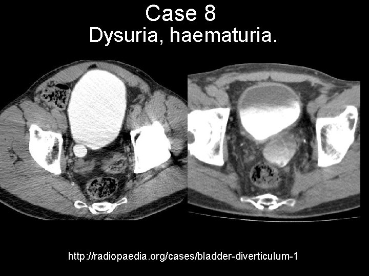 Case 8 Dysuria, haematuria. http: //radiopaedia. org/cases/bladder-diverticulum-1 